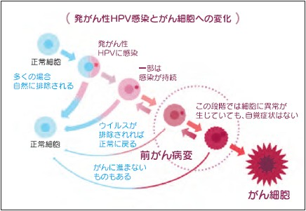 イメージ図 子宮頸がんになるまで