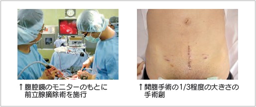 イメージ図 腹腔鏡小切開手術