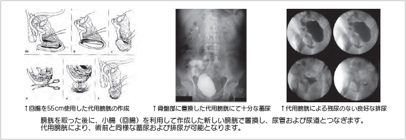 イメージ図 Studer式回腸代用膀胱造設術