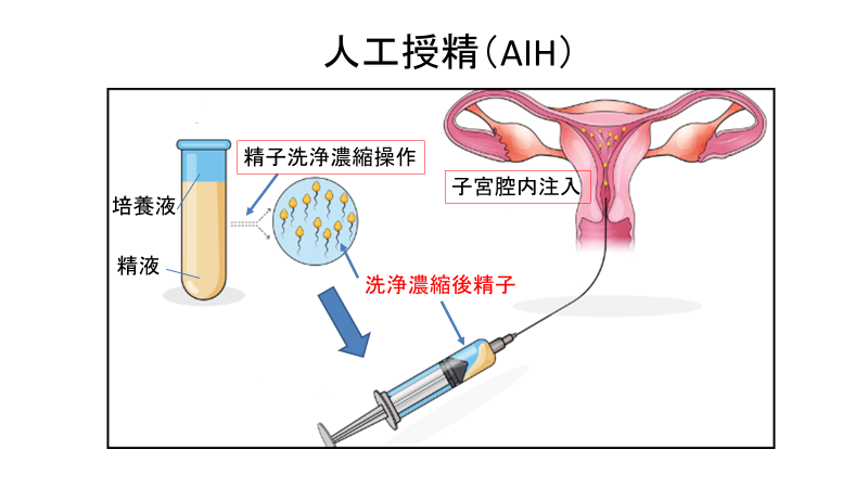イメージ図 人工授精