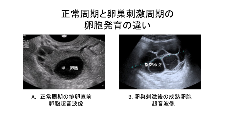イメージ図 正常周期と卵巣刺激周期の卵胞発育の違い