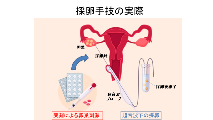 イメージ図 採卵手技の実際