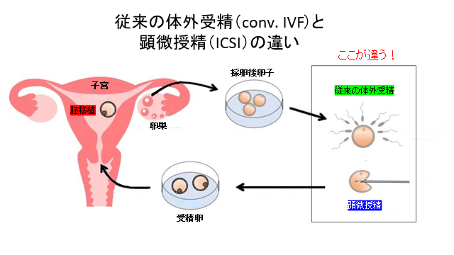 イメージ図 従来の体外受精と顕微授精の違い