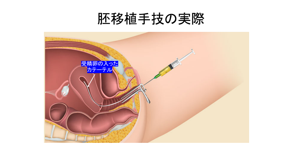 イメージ図 胚移植手術の実際