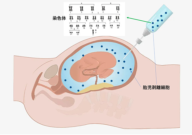 イメージ図 羊水染色体検査