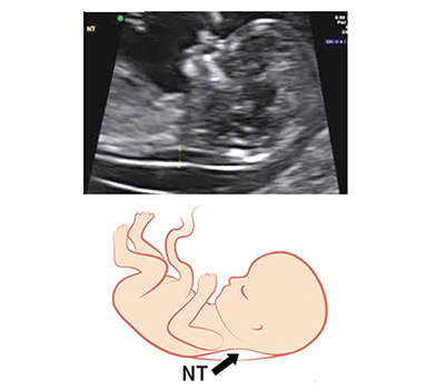 イメージ図 NT(Nuchal Translucency)