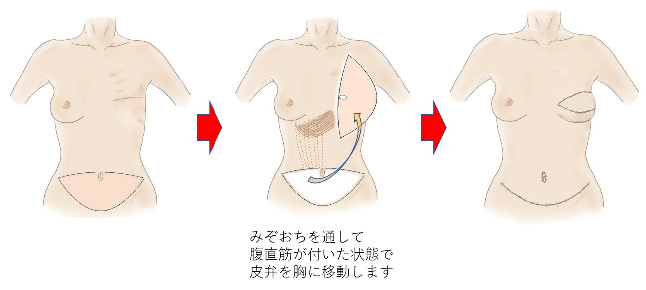 イメージ図 乳房再建