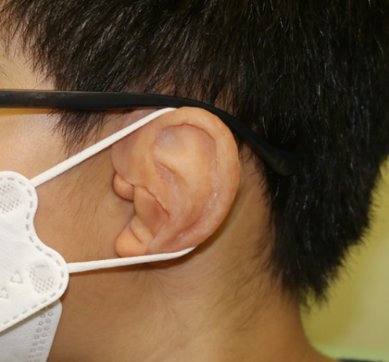 写真 エピテーゼ2