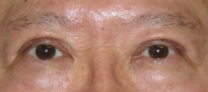 写真 眼窩下垂手術2