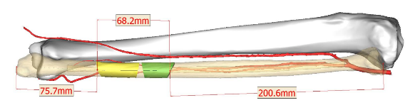 イメージ図　頭頚部再建7