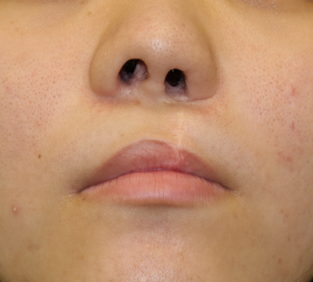 写真 口唇裂初回手術12