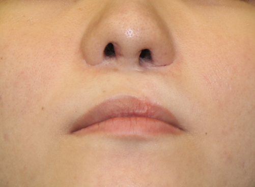 写真 口唇裂初回手術14