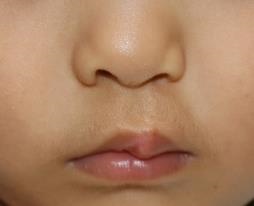 写真 口唇裂初回手術2