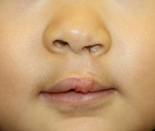 写真 口唇裂初回手術4