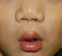 写真　口唇裂初回手術6