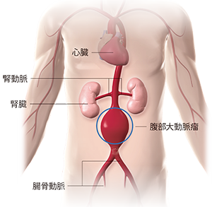 イメージ図 ステントグラフト内挿術 血管内治療