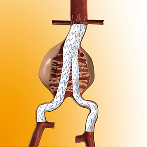 イメージ図 ステントグラフト内挿術 血管内治療