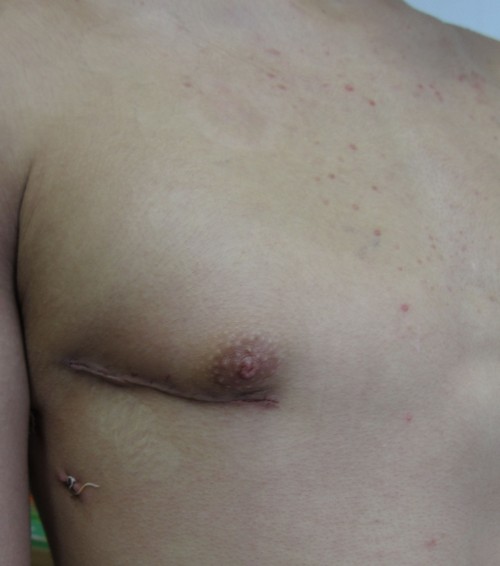 写真 小切開右側方開胸開心術 右側方開胸創