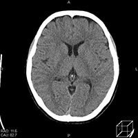 イメージ図 CT画像